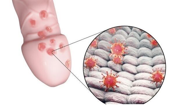 alergi terhadap gel pembesar penis