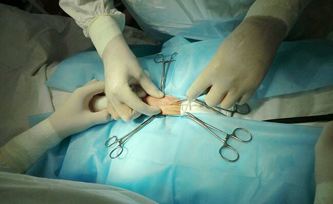 Pembedahan pada organ reproduksi akan membantu memperbesar ukurannya